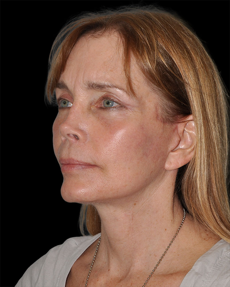 Facelift Before & After Patient #8959
