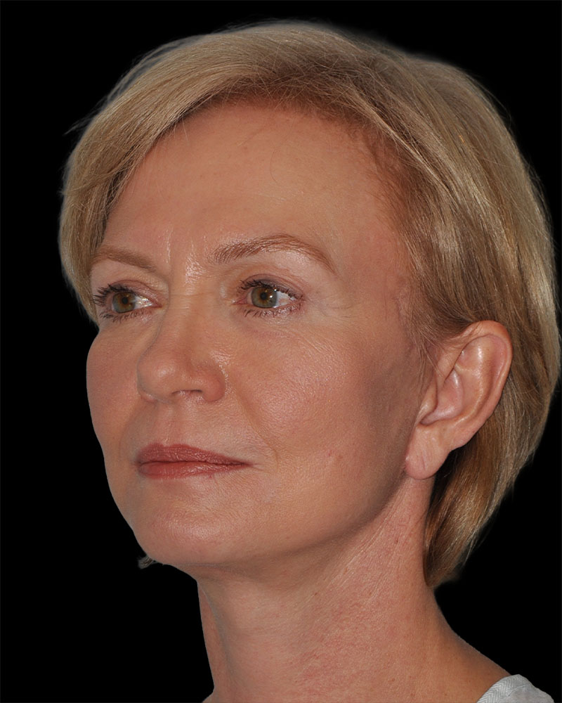 Facelift Before & After Patient #9131