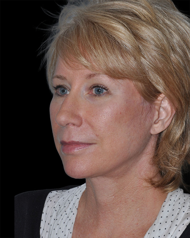 Facelift Before & After Patient #9135