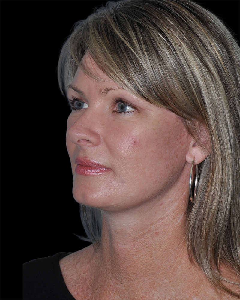 Facelift Before & After Patient #9138