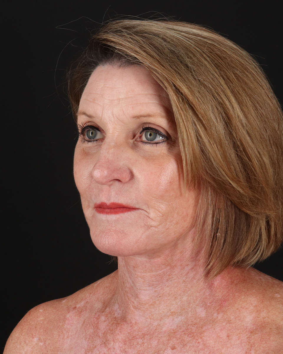 Facelift Before & After Patient #8944