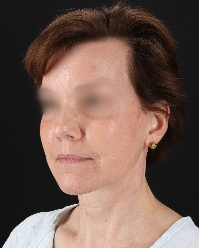 Facelift Before & After Patient #9173