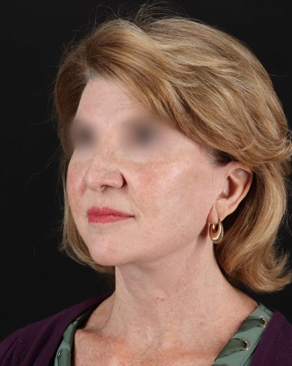 Facelift Before & After Patient #9140