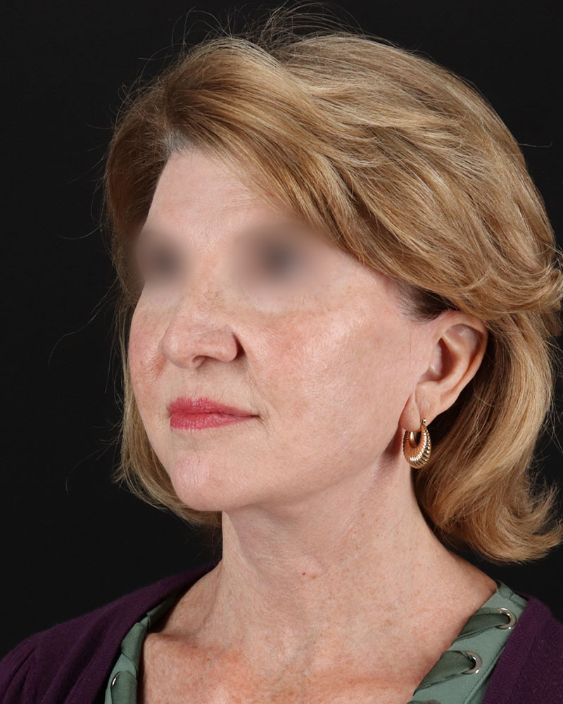 Facelift Before & After Patient #9140