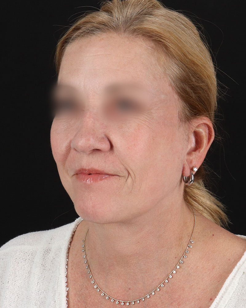 Facelift Before & After Patient #8957