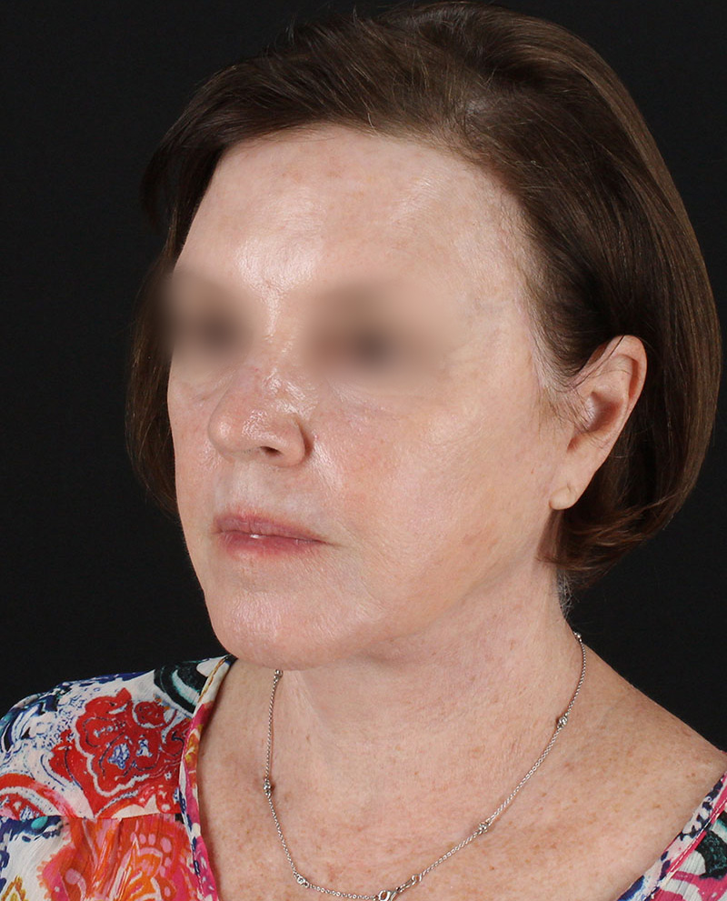 Facelift Before & After Patient #8954