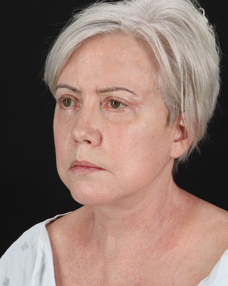 Facelift Before & After Patient #8946