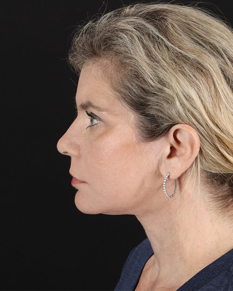 Facelift Before & After Patient #8947
