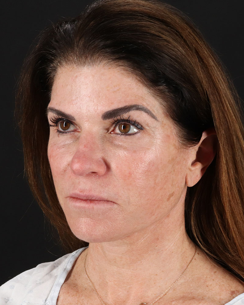 Facelift Before & After Patient #8949