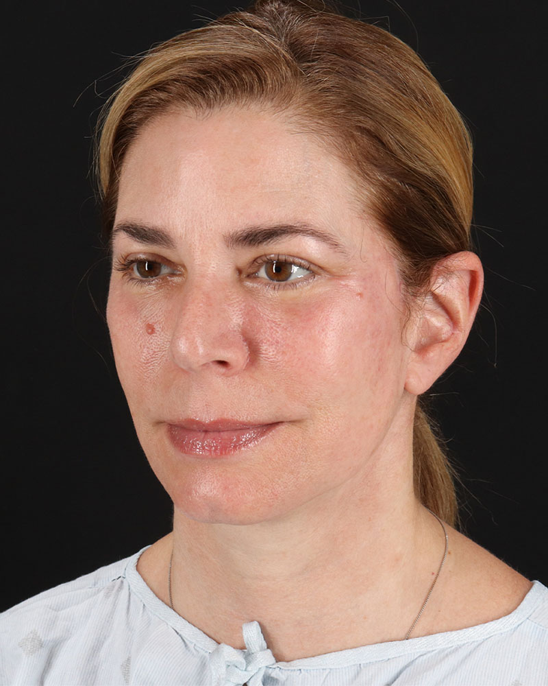 Lower Blepharoplasty Before & After Patient #8951