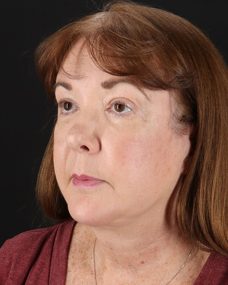 Facelift Before & After Patient #8953