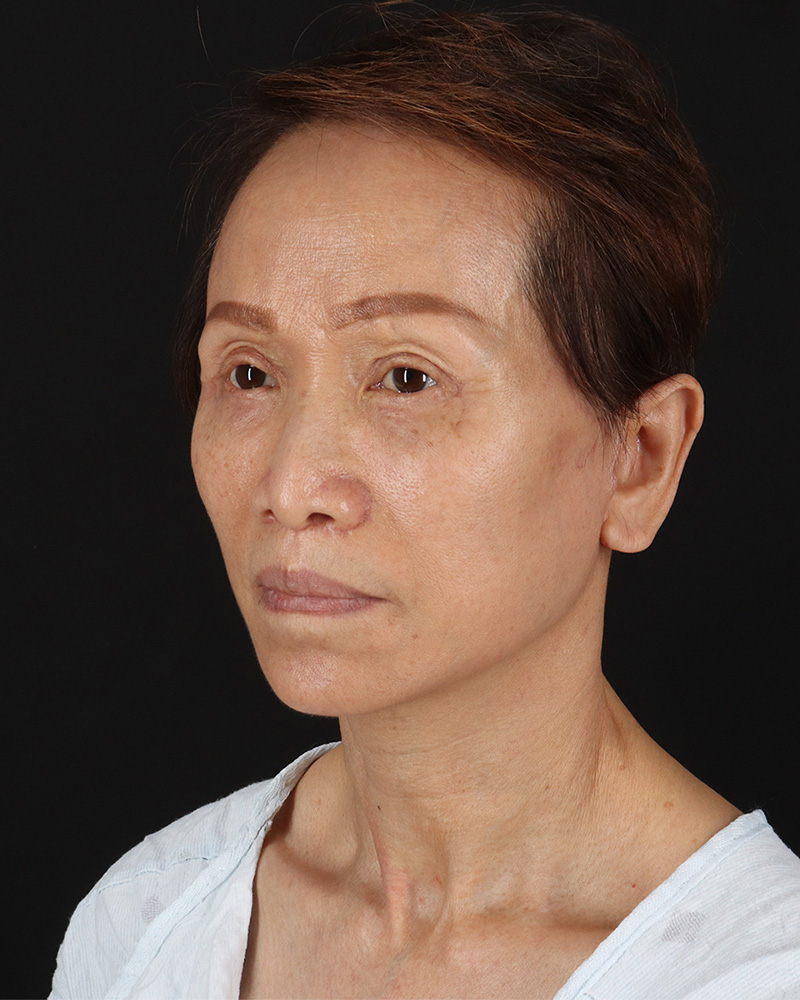 Facelift Before & After Patient #8950
