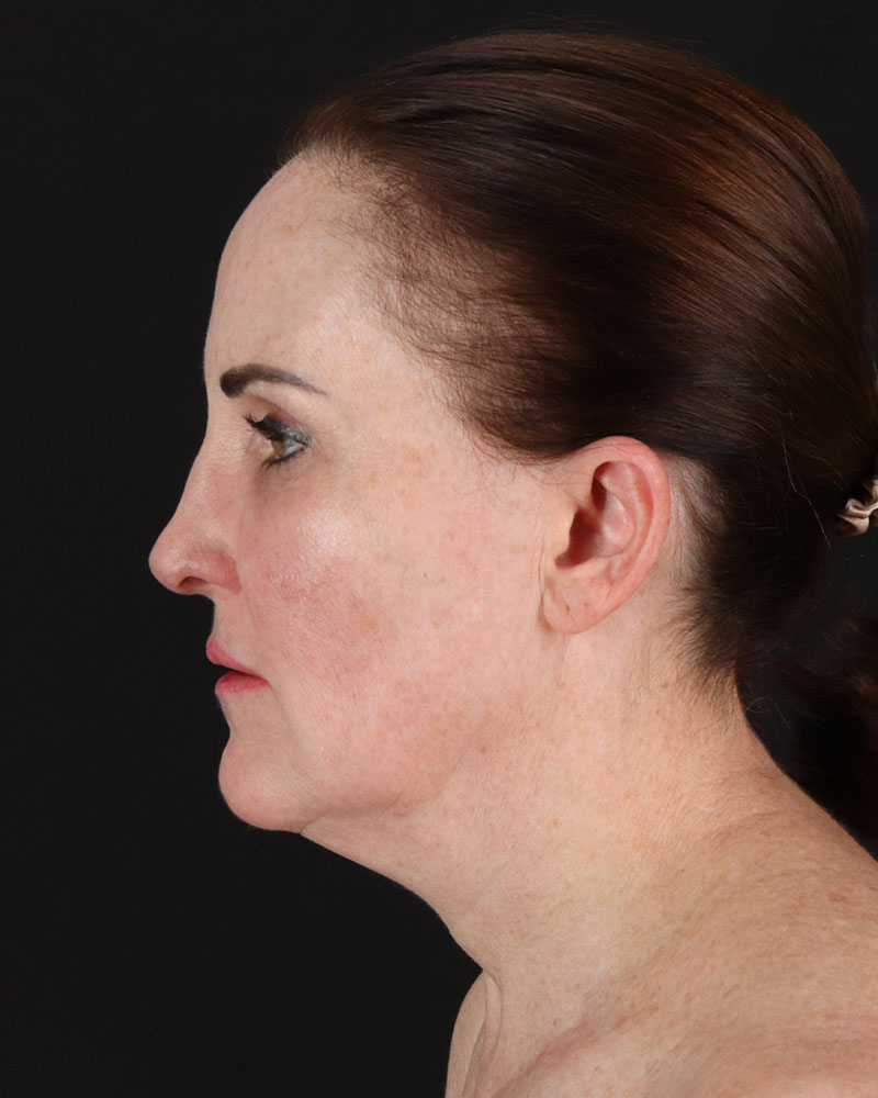 Facelift Before & After Patient #8943