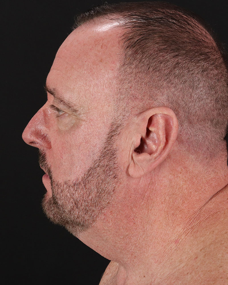 Facelift Before & After Patient #8955