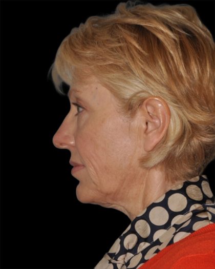 Facelift Before & After Patient #8958