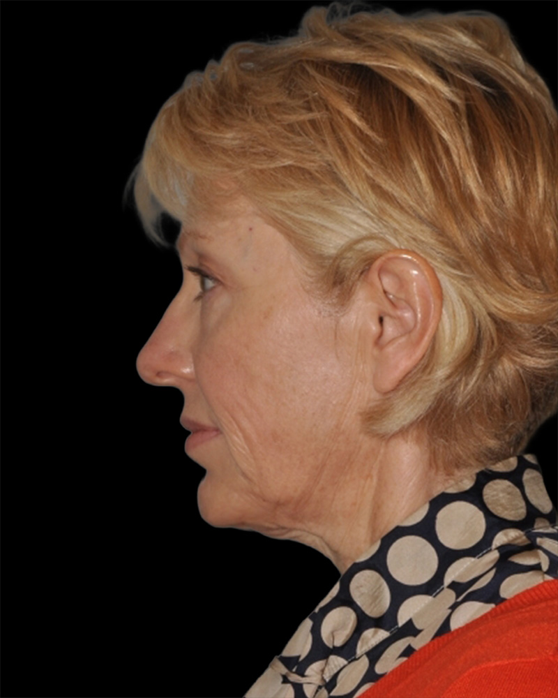 Facelift Before & After Patient #8958