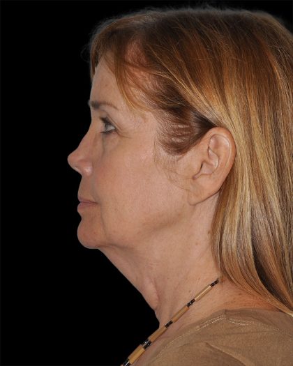 Facelift Before & After Patient #8959