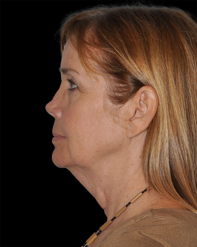 Facelift Before & After Patient #8959