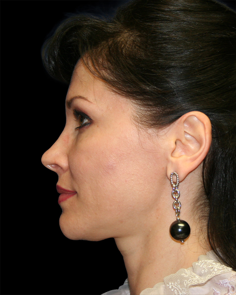 Facelift Before & After Patient #8960