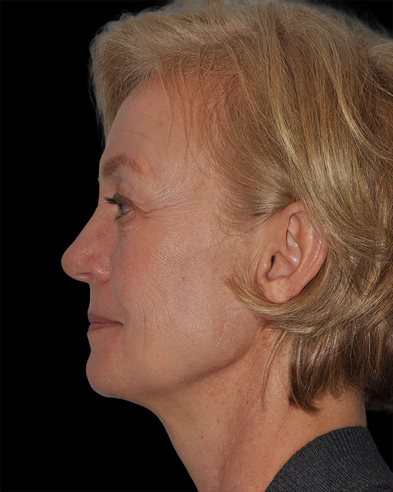 Facelift Before & After Patient #9131
