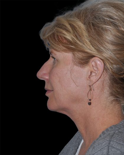 Facelift Before & After Patient #9135