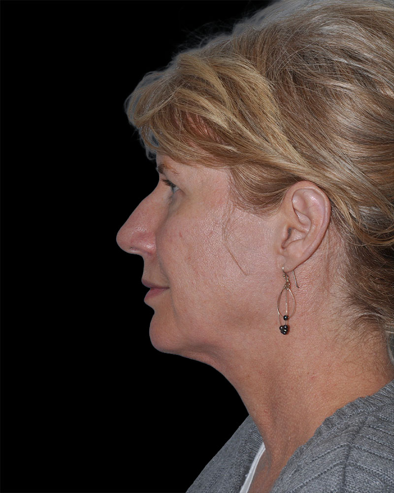 Facelift Before & After Patient #9135
