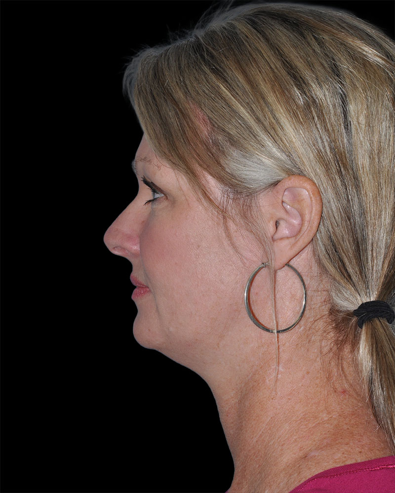 Facelift Before & After Patient #9138