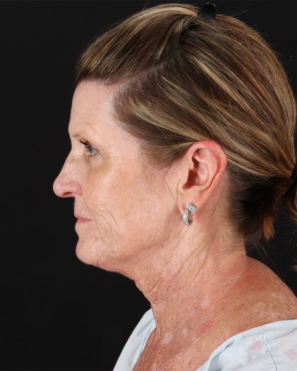 Facelift Before & After Patient #8944