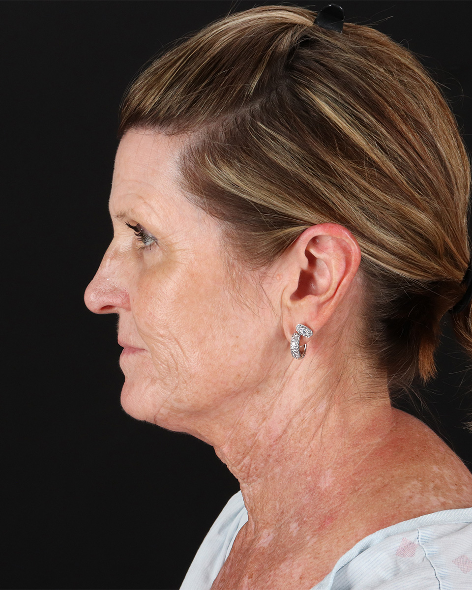Facelift Before & After Patient #8944