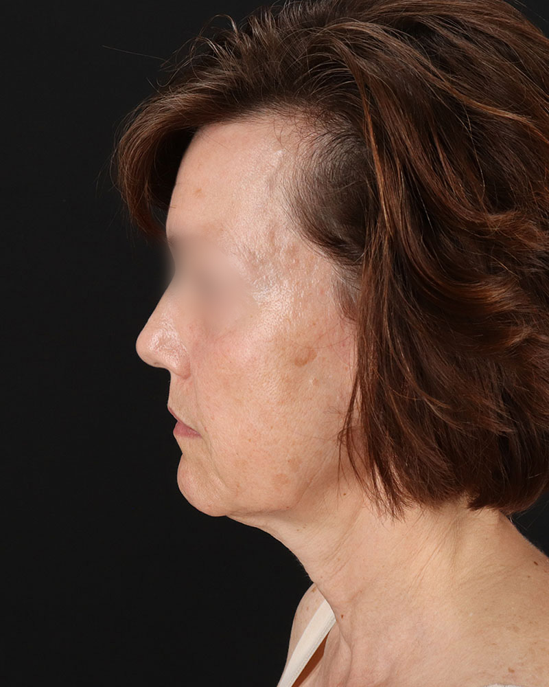 Facelift Before & After Patient #9173