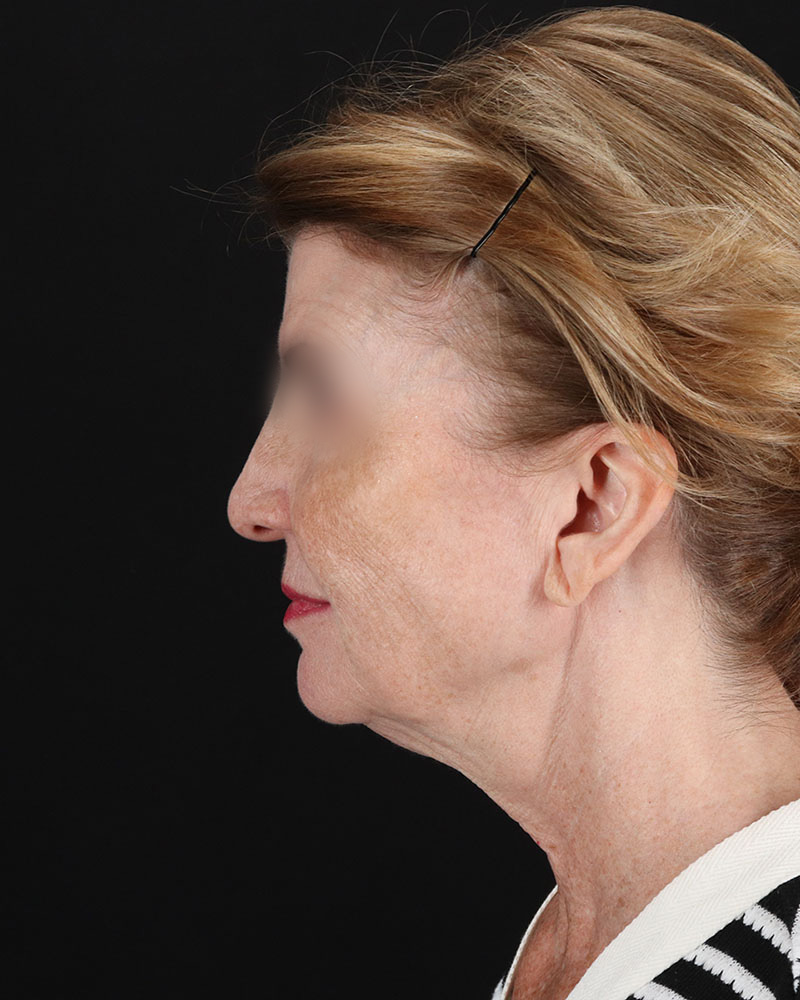 Facelift Before & After Patient #9140