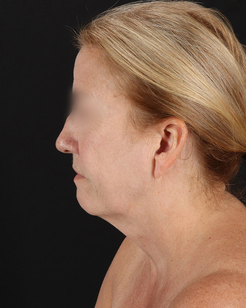 Facelift Before & After Patient #8957