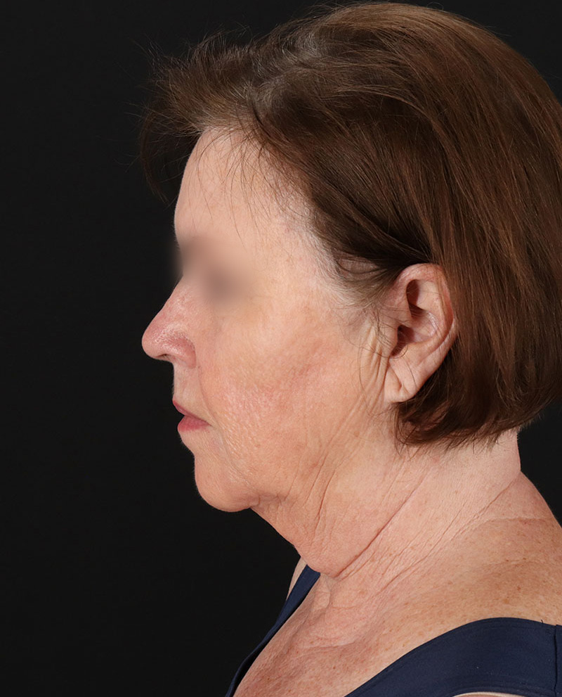 Facelift Before & After Patient #8954