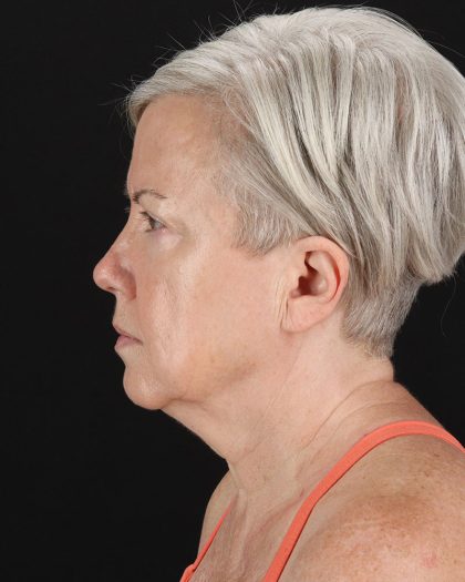 Facelift Before & After Patient #8946