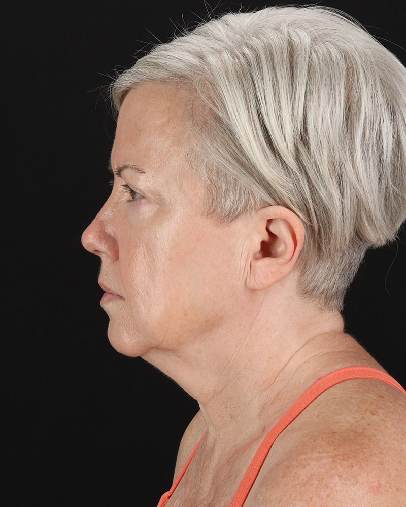 Facelift Before & After Patient #8946