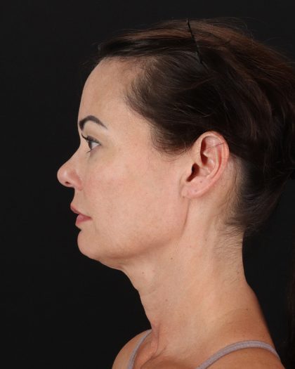Facelift Before & After Patient #8942