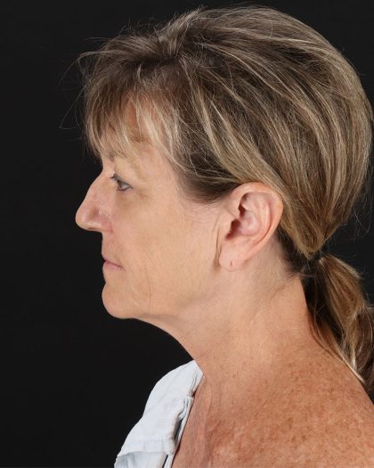 Facelift Before & After Patient #8948