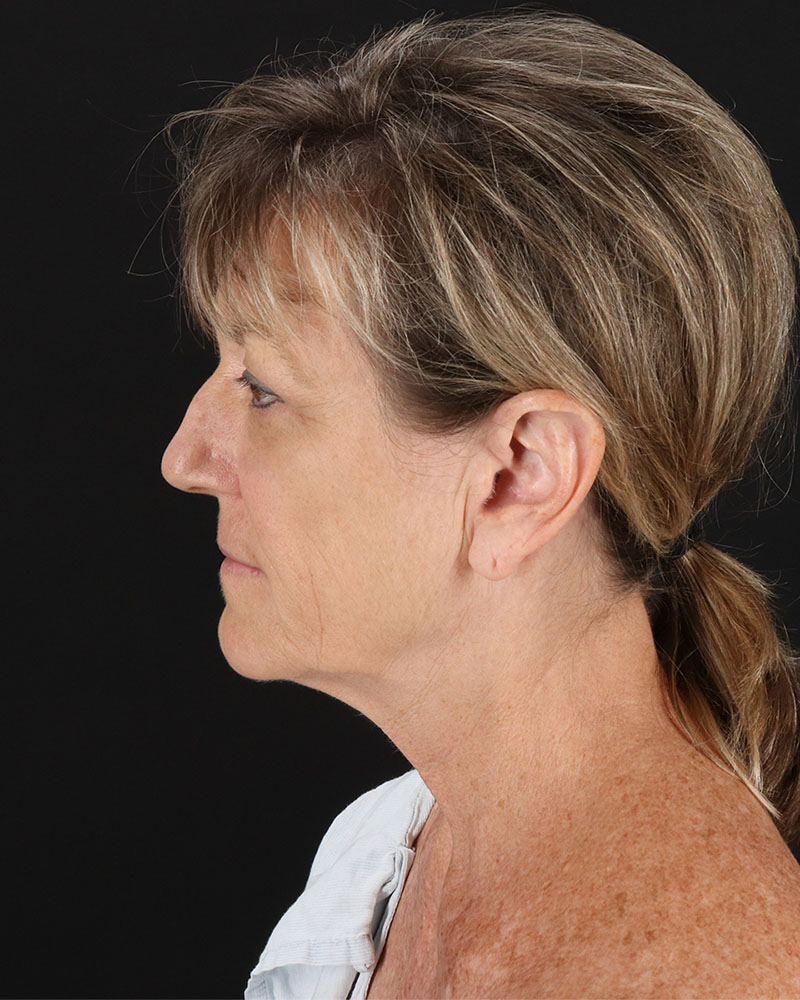 Facelift Before & After Patient #8948
