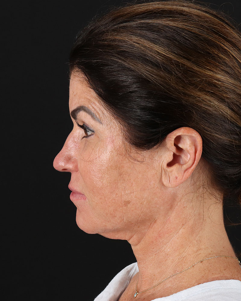 Facelift Before & After Patient #8949