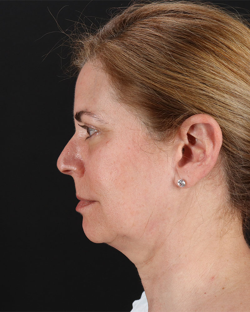Lower Blepharoplasty Before & After Patient #8951