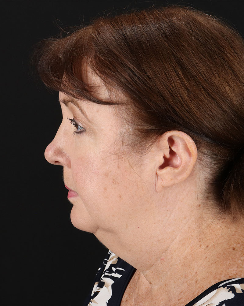 Facelift Before & After Patient #8953