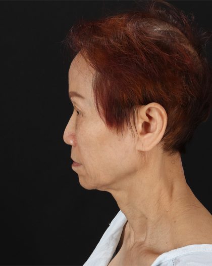 Facelift Before & After Patient #8950