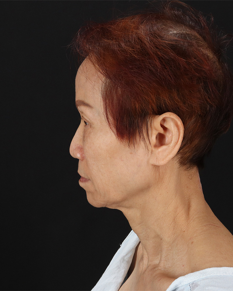 Facelift Before & After Patient #8950