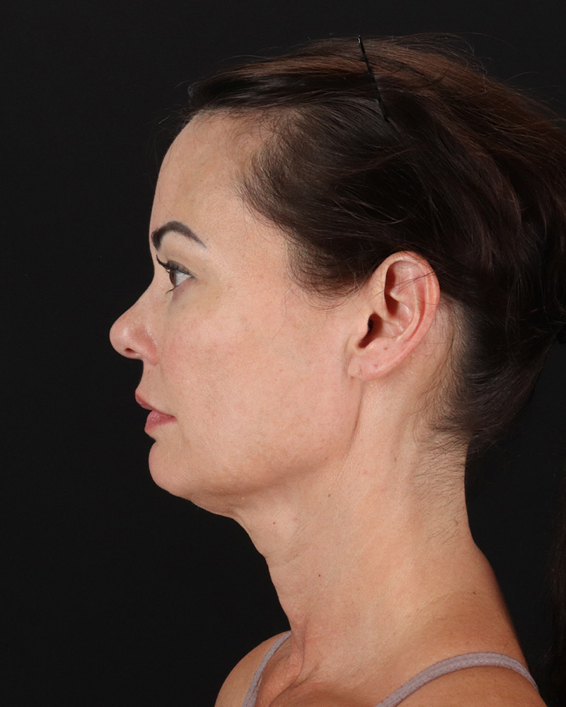 Facelift Before & After Patient #8942