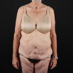 Fleur De Lis Tummy Tuck Before & After Patient #9505