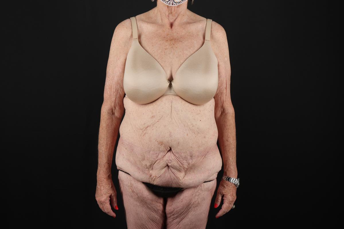 Fleur De Lis Tummy Tuck Before & After Patient #9505
