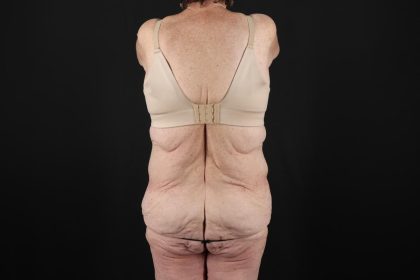 Fleur De Lis Tummy Tuck Before & After Patient #9505