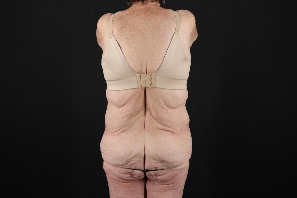 Fleur De Lis Tummy Tuck Before & After Patient #9505