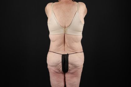 Fleur De Lis Tummy Tuck Before & After Patient #9505