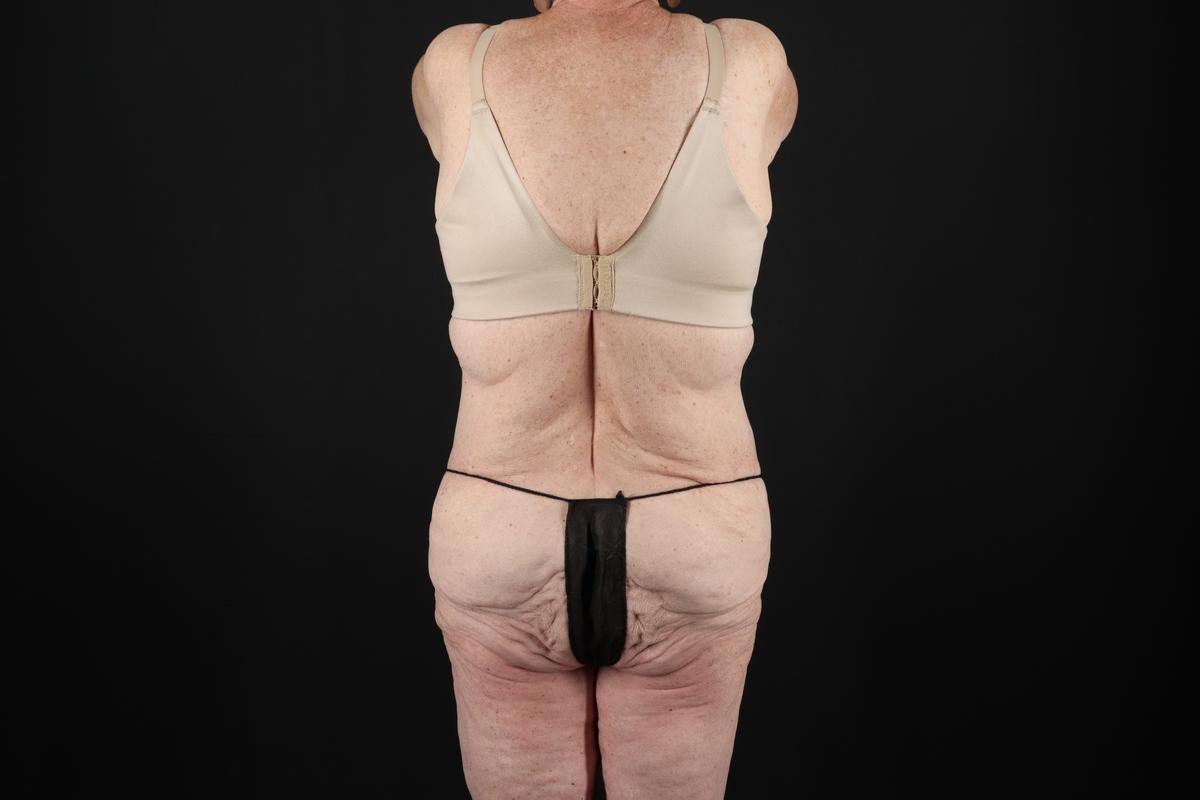 Fleur De Lis Tummy Tuck Before & After Patient #9505